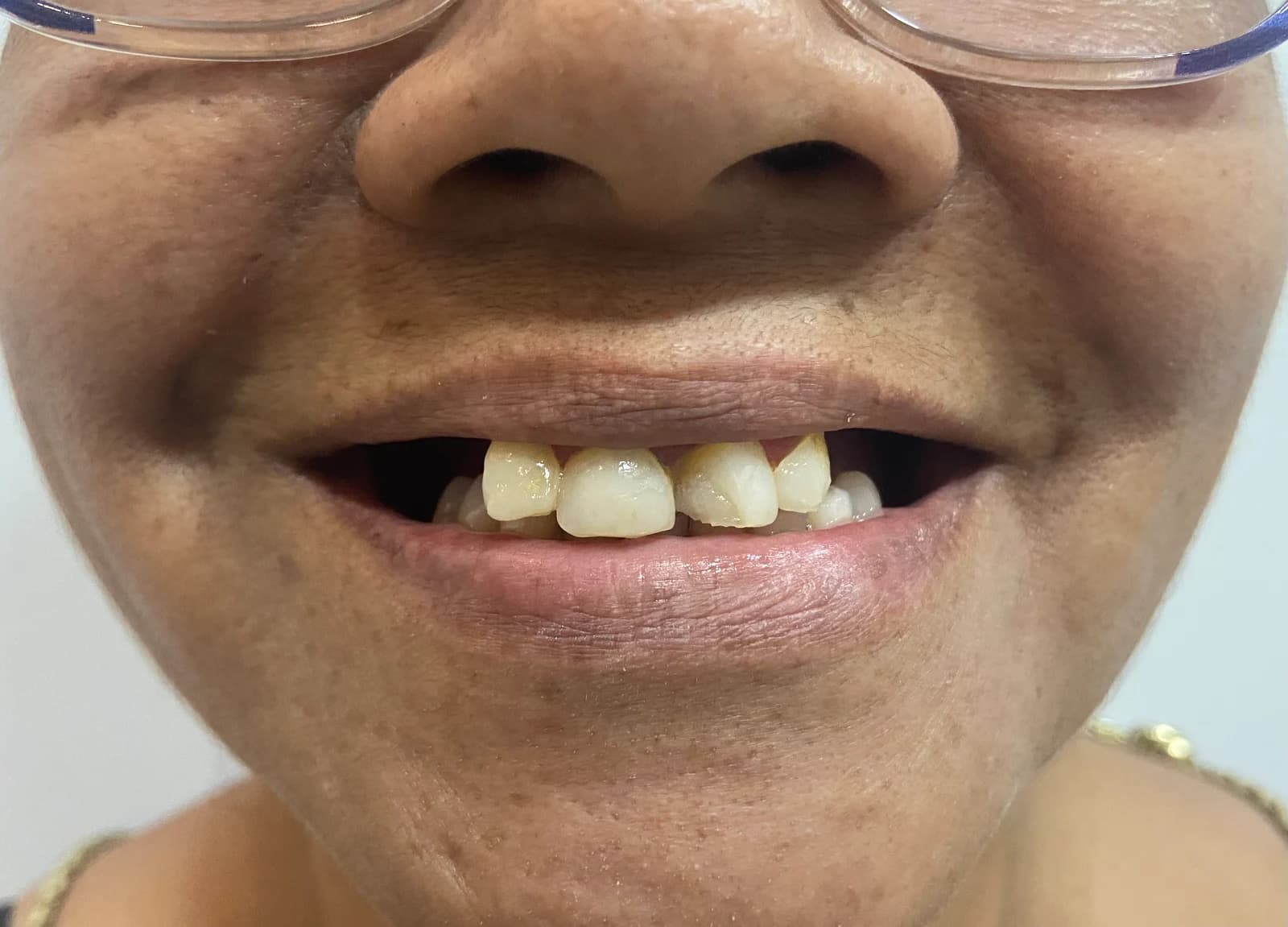 Sorriso antes do tratamento de facetas dentárias