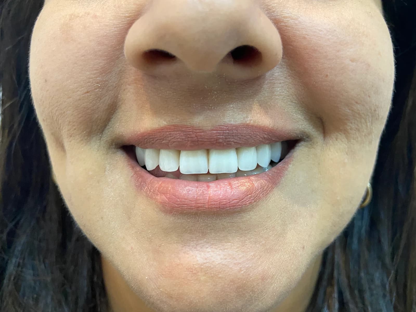 Sorriso depois do tratamento de facetas dentárias